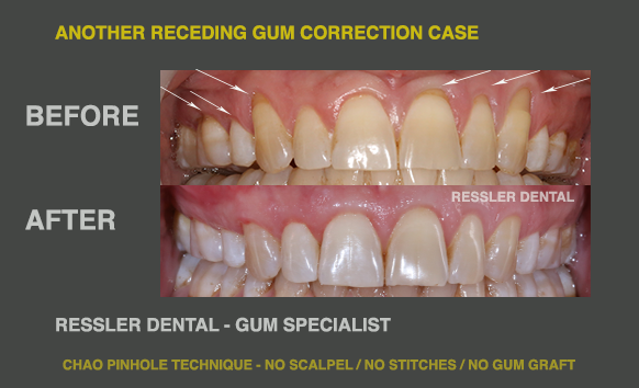 pinhole receding gum surgery fix