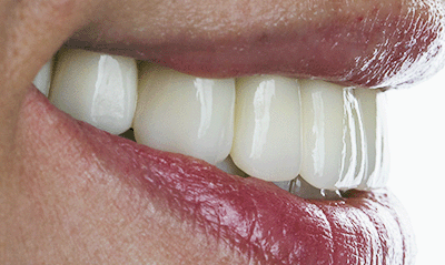 cosmetic gum lift and front tooth implant
