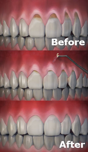 receding gums surgery before and after